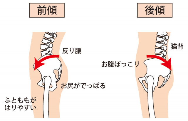 反り腰、猫背の説明