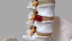 腰椎椎間板ヘルニアの人体模型