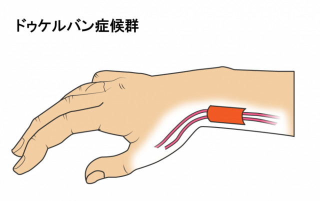 ドケルバン症候群