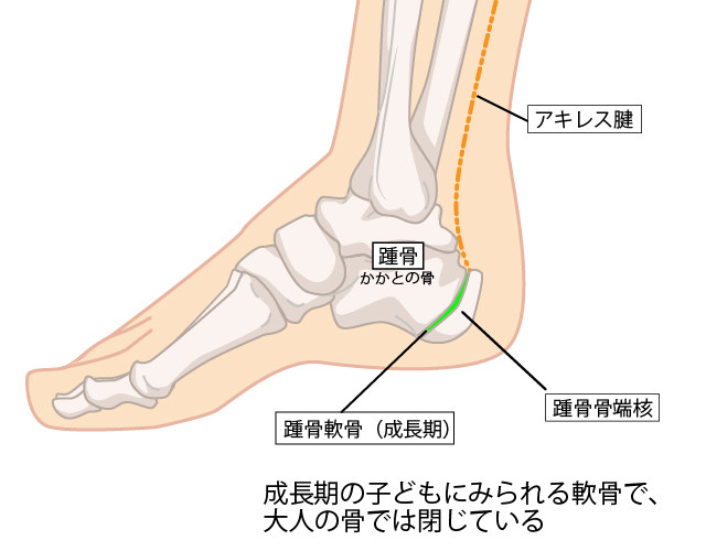 踵骨骨端症